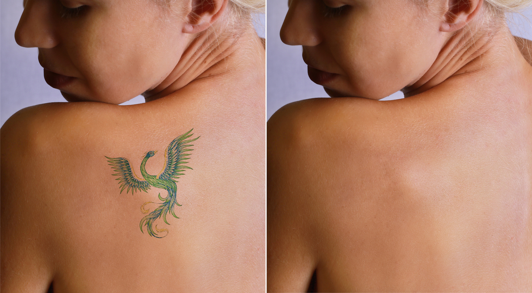 Eliminazione tatuaggi: 8 cose da sapere prima di rimuoverlo