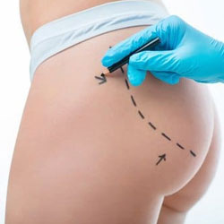 Gluteoplastica con protesi glutee Gluteoplastica con protesi glutee