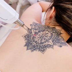 Rimozione tatuaggi Rimozione tatuaggi